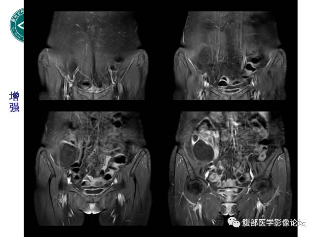 【病例】右附件浆液性囊腺瘤1例CT及MR影像表现