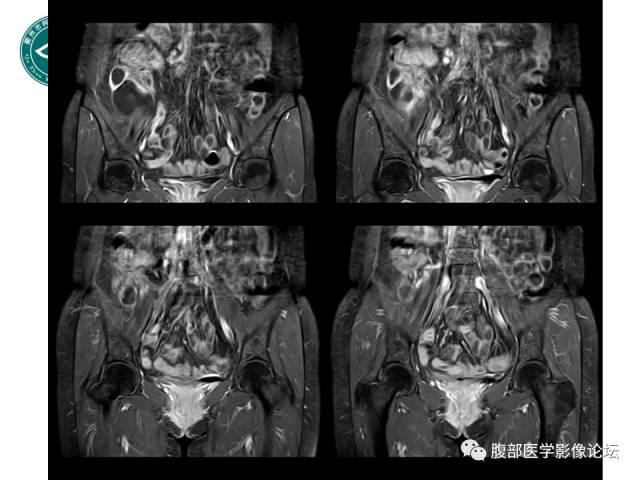 【病例】右附件浆液性囊腺瘤1例CT及MR影像表现