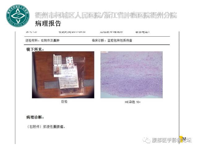 【病例】右附件浆液性囊腺瘤1例CT及MR影像表现