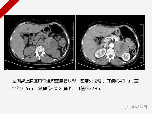 【病例】肾上腺嗜铬细胞瘤1例CT影像表现