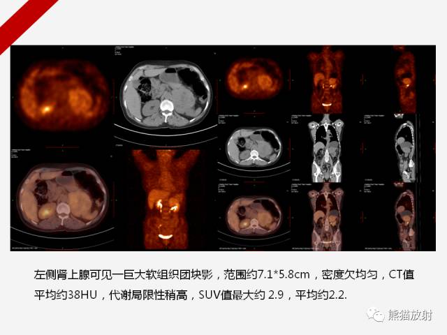 【病例】肾上腺嗜铬细胞瘤1例CT影像表现