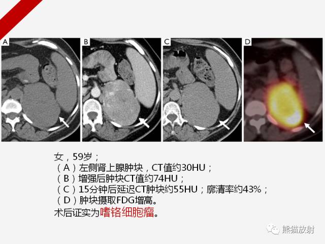 【病例】肾上腺嗜铬细胞瘤1例CT影像表现