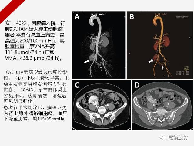 【病例】肾上腺嗜铬细胞瘤1例CT影像表现