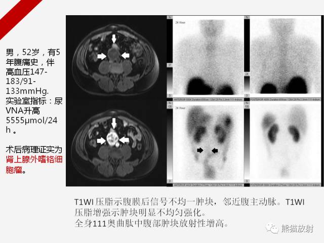 【病例】肾上腺嗜铬细胞瘤1例CT影像表现