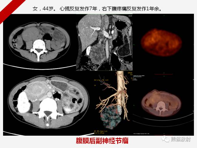 【病例】肾上腺嗜铬细胞瘤1例CT影像表现
