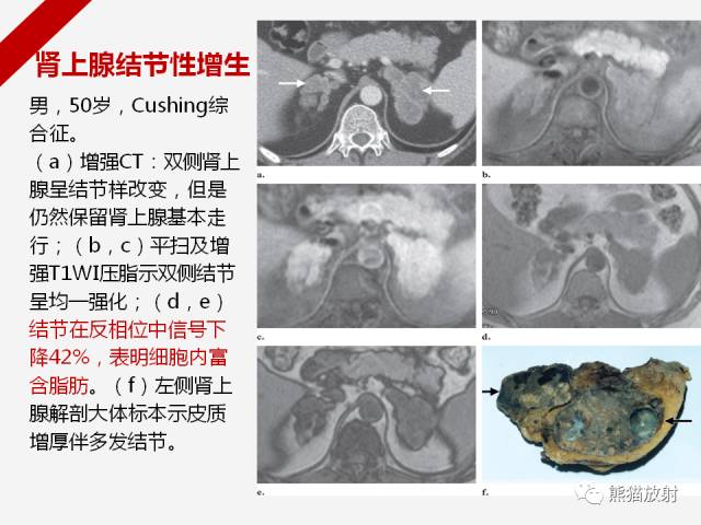 【病例】肾上腺嗜铬细胞瘤1例CT影像表现
