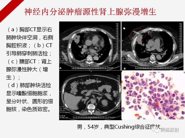 【病例】肾上腺嗜铬细胞瘤1例CT影像表现