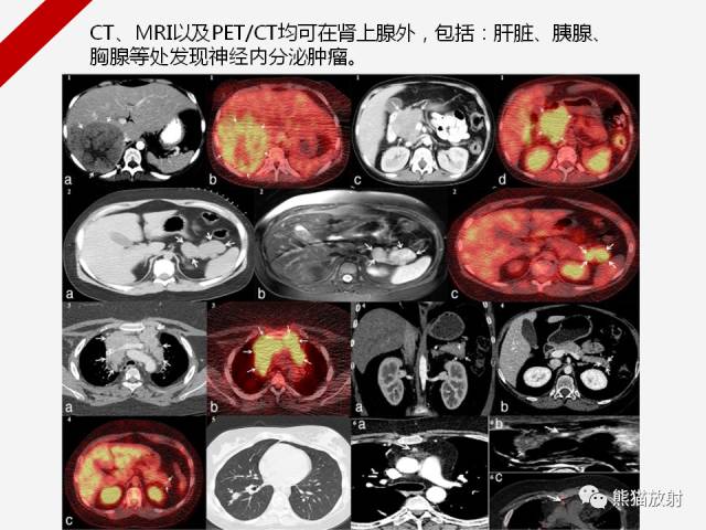 【病例】肾上腺嗜铬细胞瘤1例CT影像表现