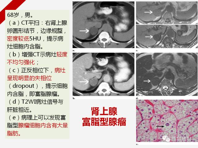 【病例】肾上腺嗜铬细胞瘤1例CT影像表现