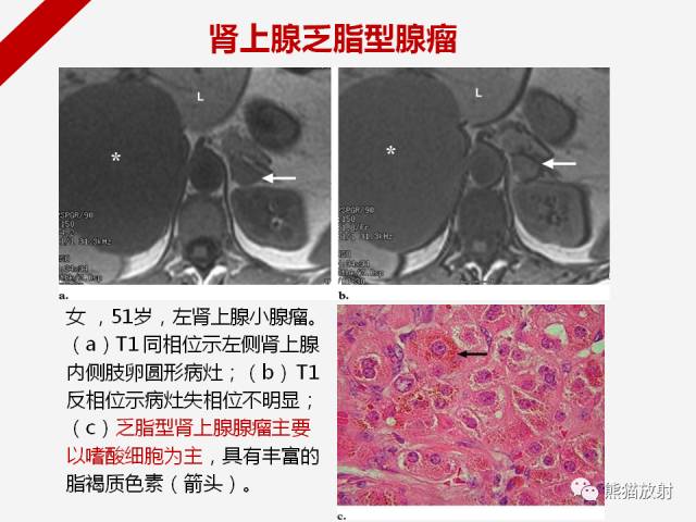 【病例】肾上腺嗜铬细胞瘤1例CT影像表现