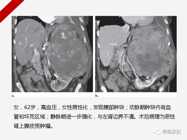 【病例】肾上腺嗜铬细胞瘤1例CT影像表现
