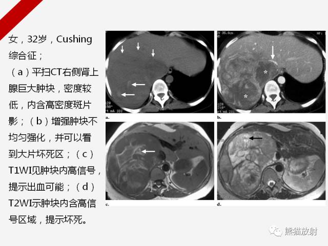 【病例】肾上腺嗜铬细胞瘤1例CT影像表现