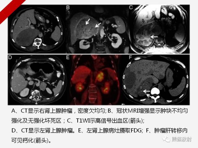 【病例】肾上腺嗜铬细胞瘤1例CT影像表现