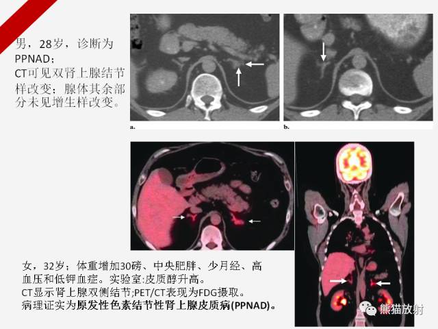 【病例】肾上腺嗜铬细胞瘤1例CT影像表现