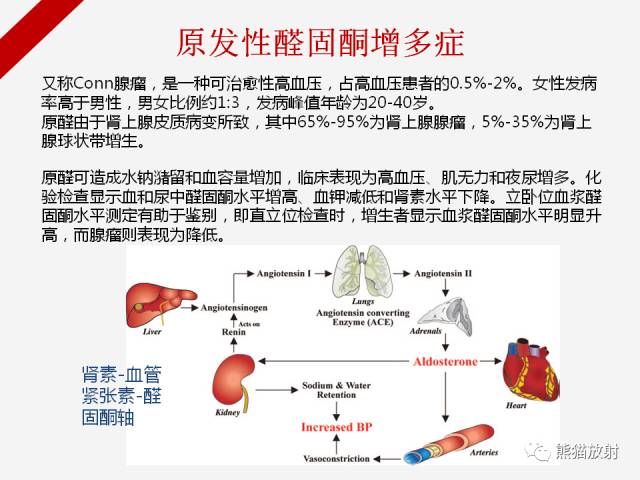 【病例】肾上腺嗜铬细胞瘤1例CT影像表现
