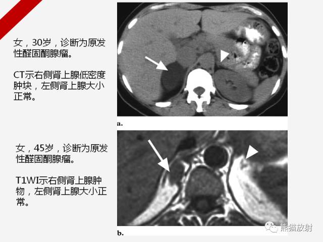 【病例】肾上腺嗜铬细胞瘤1例CT影像表现