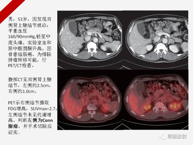 【病例】肾上腺嗜铬细胞瘤1例CT影像表现