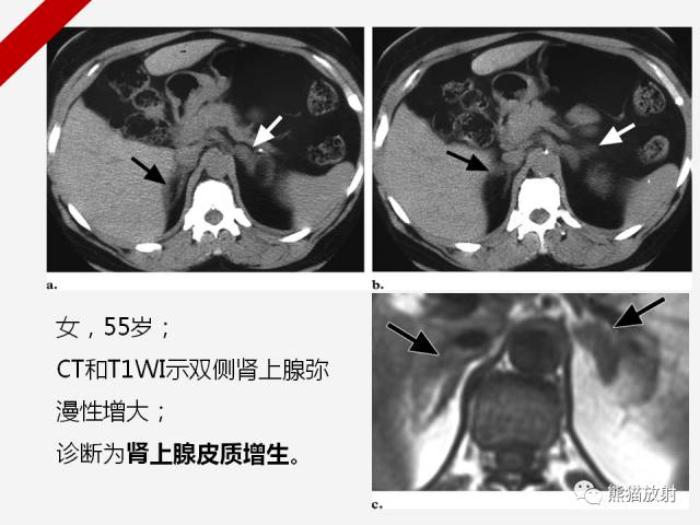 【病例】肾上腺嗜铬细胞瘤1例CT影像表现