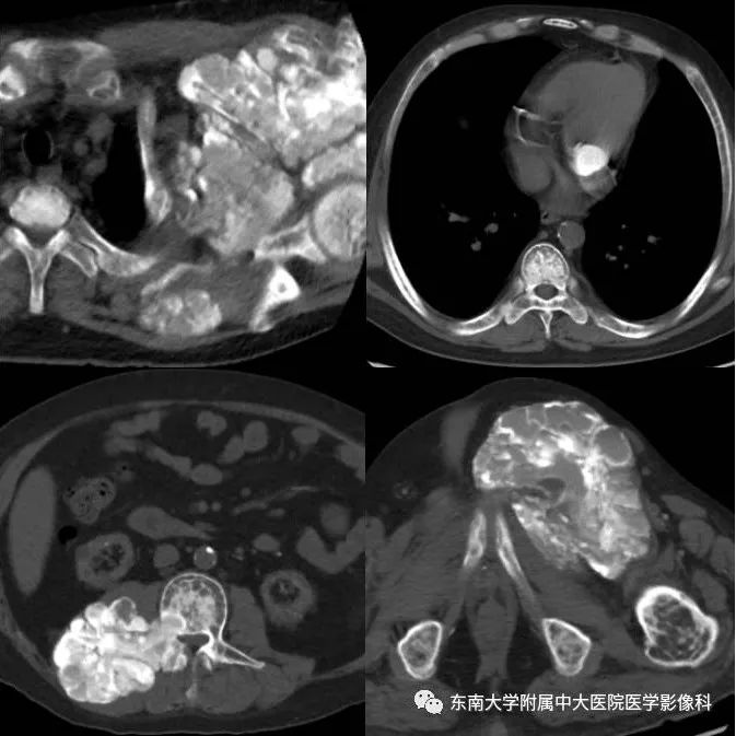 【病例】肾性骨病/肾性骨营养不良1例CT影像表现