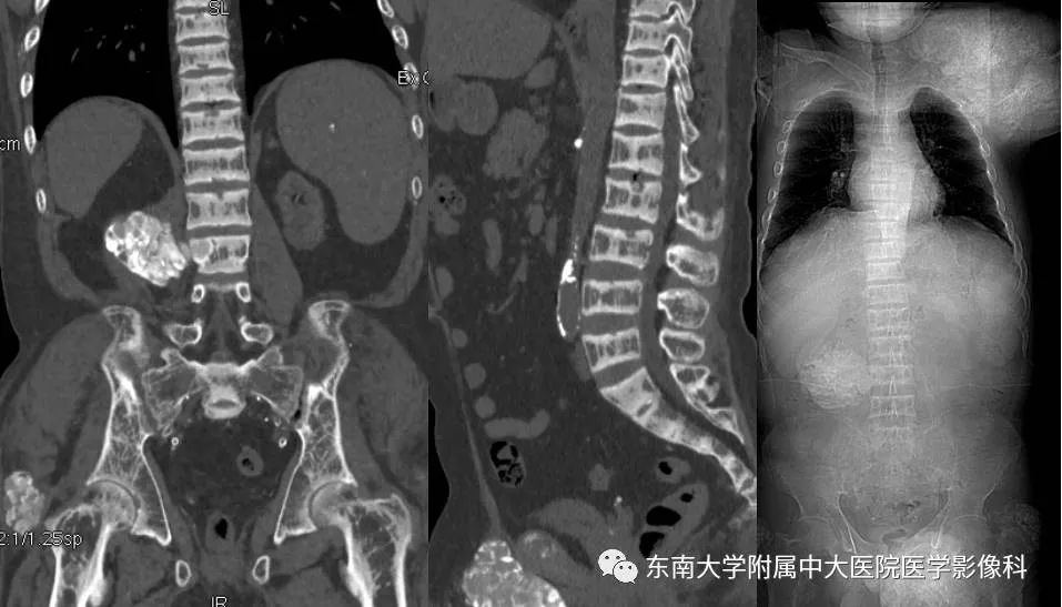 【病例】肾性骨病/肾性骨营养不良1例CT影像表现 【病例】肾性骨病/肾性骨营养不良1例CT影像表现
