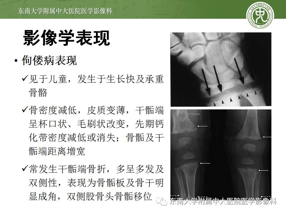 【病例】肾性骨病/肾性骨营养不良1例CT影像表现 【病例】肾性骨病/肾性骨营养不良1例CT影像表现