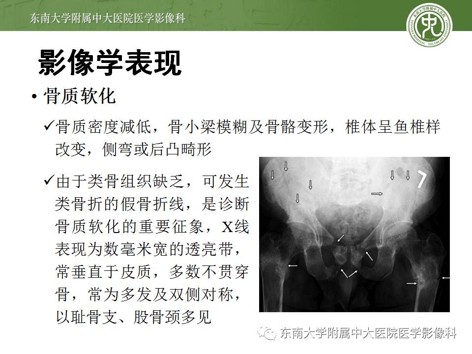 【病例】肾性骨病/肾性骨营养不良1例CT影像表现 【病例】肾性骨病/肾性骨营养不良1例CT影像表现