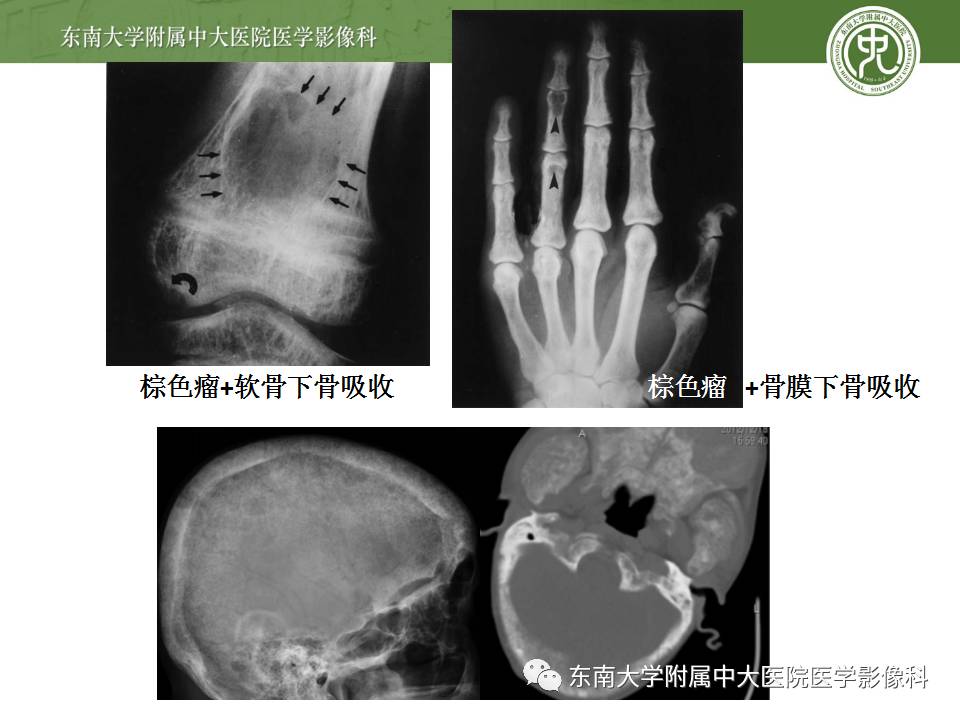 【病例】肾性骨病/肾性骨营养不良1例CT影像表现 【病例】肾性骨病/肾性骨营养不良1例CT影像表现