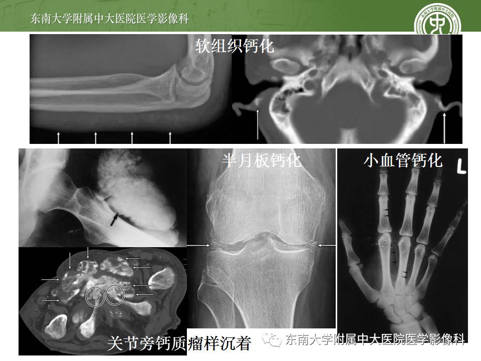 【病例】肾性骨病/肾性骨营养不良1例CT影像表现 【病例】肾性骨病/肾性骨营养不良1例CT影像表现