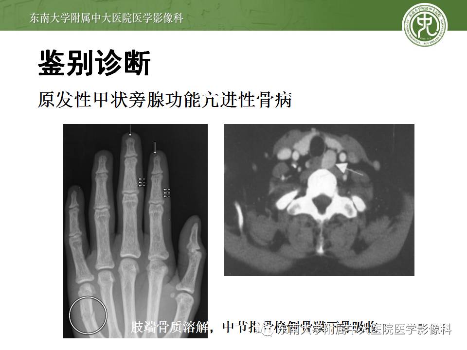 【病例】肾性骨病/肾性骨营养不良1例CT影像表现 【病例】肾性骨病/肾性骨营养不良1例CT影像表现