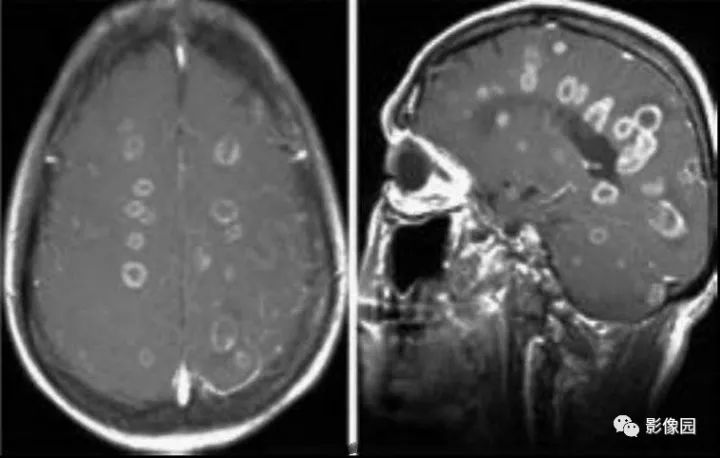【病例】脑囊虫病1例MR影像表现 【病例】脑囊虫病1例MR影像表现