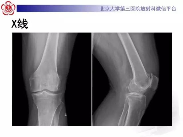 【病例】膝关节树枝状脂肪瘤1例MR影像表现