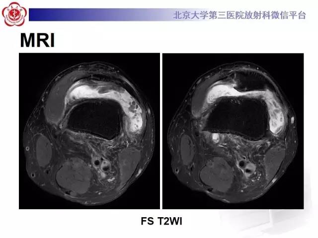 【病例】膝关节树枝状脂肪瘤1例MR影像表现