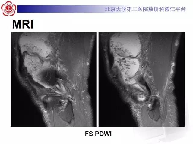 【病例】膝关节树枝状脂肪瘤1例MR影像表现