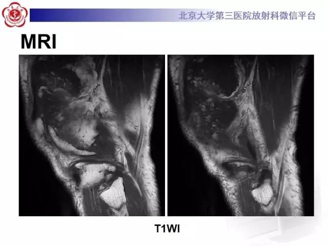 【病例】膝关节树枝状脂肪瘤1例MR影像表现
