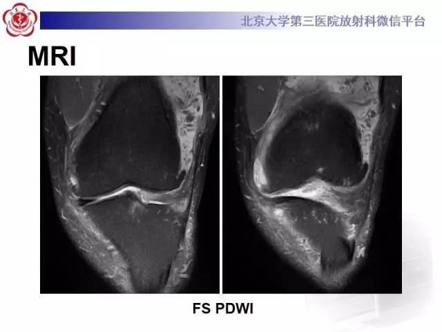 【病例】膝关节树枝状脂肪瘤1例MR影像表现