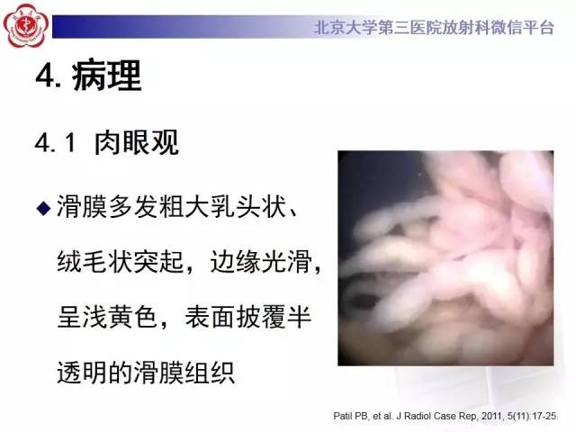 【病例】膝关节树枝状脂肪瘤1例MR影像表现