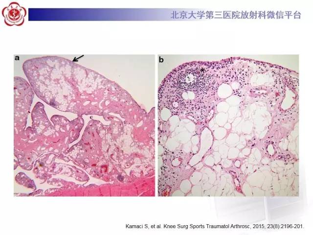 【病例】膝关节树枝状脂肪瘤1例MR影像表现