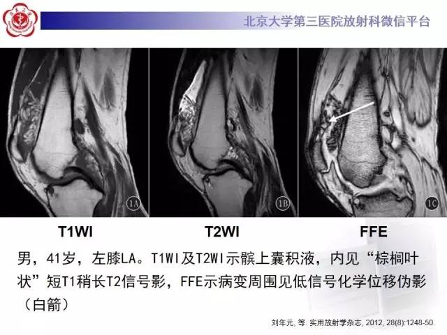 【病例】膝关节树枝状脂肪瘤1例MR影像表现