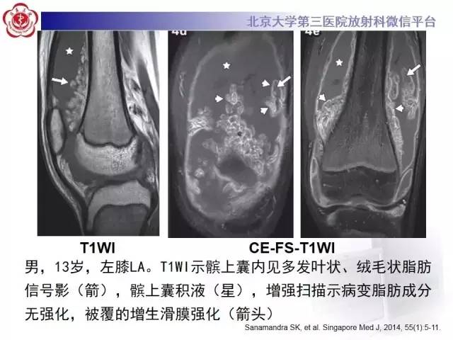 【病例】膝关节树枝状脂肪瘤1例MR影像表现