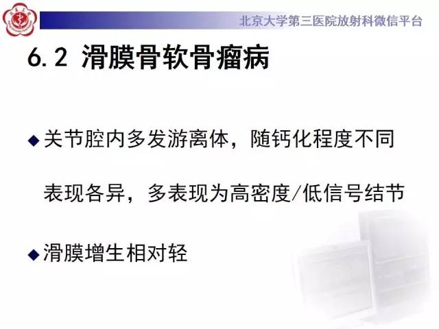 【病例】膝关节树枝状脂肪瘤1例MR影像表现