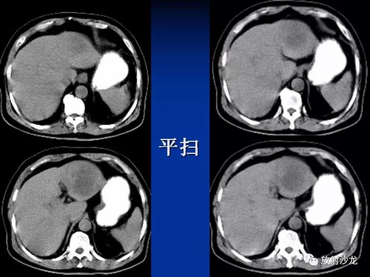 【病例】肝囊肿伴液化坏死部分出血1例MR