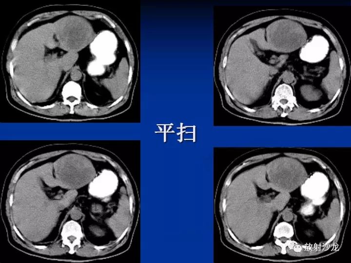【病例】肝囊肿伴液化坏死部分出血1例MR