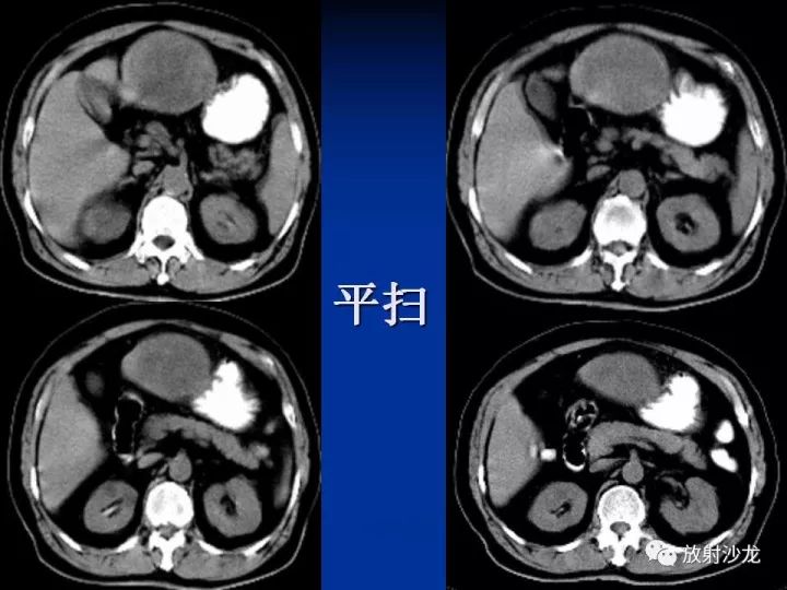 【病例】肝囊肿伴液化坏死部分出血1例MR