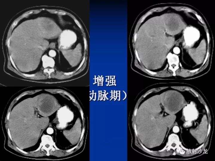 【病例】肝囊肿伴液化坏死部分出血1例MR