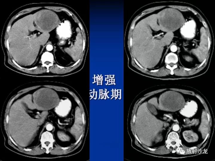 【病例】肝囊肿伴液化坏死部分出血1例MR