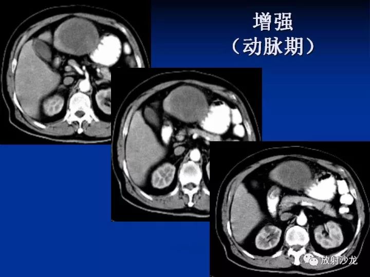 【病例】肝囊肿伴液化坏死部分出血1例MR