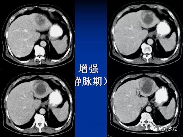 【病例】肝囊肿伴液化坏死部分出血1例MR
