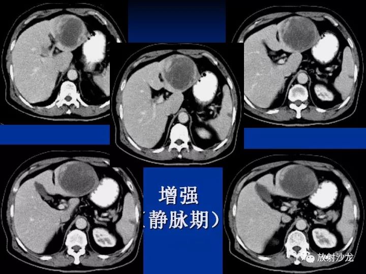 【病例】肝囊肿伴液化坏死部分出血1例MR