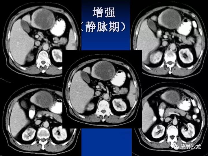【病例】肝囊肿伴液化坏死部分出血1例MR