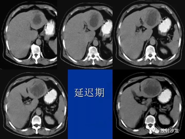 【病例】肝囊肿伴液化坏死部分出血1例MR